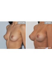 Breast Augmentation - Dr James Southwell-Keely - Woollahra Clinic