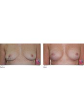 Breast Reconstruction - Dr James Southwell-Keely - Woollahra Clinic