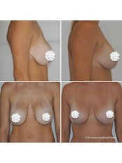 Augmentation Mastopexy - Dr James Southwell-Keely - Woollahra Clinic