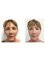 Dr David Sharp Plastic Surgery and The Sharp Cosmetic Clinics - Brisbane - before and after facelift surgery with Dr Sharp 