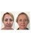 Dr David Sharp Plastic Surgery and The Sharp Cosmetic Clinics - Brisbane - before and after blepharoplasty with Dr Sharp 