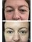 Dr David Sharp Plastic Surgery and The Sharp Cosmetic Clinics - Brisbane - before and after blepharoplasty eyelid reduction with Dr Sharp 
