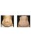 Dr David Sharp Plastic Surgery and The Sharp Cosmetic Clinics - Brisbane - before and after abdominoplasty with Dr Sharp 