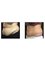 Dr David Sharp Plastic Surgery + PRAHS Cosmetic Clinics Brisbane - before and after abdominoplasty with Dr Sharp 