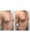 Medaesthetics Australia - Gynecomastia (male breast) Surgery- 1 day after surgery 