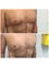 Medaesthetics Australia - Gynecomastia (male breast) Surgery 
