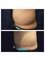Medaesthetics Australia - CoolSculpting- After one session 