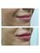 Absolute Cosmetic Medicine Nedlands - Before and After Lip Fillers 