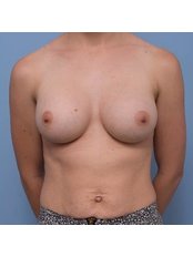 Breast Augmentation - Sam Cunneen Plastic Surgery
