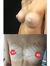 Breast Implants - Can Klinik