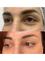 Eyelid Surgery - Can Klinik