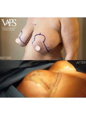Breast Lift - Vugar Clinic