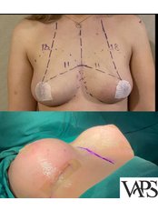 Breast Implants - Vugar Clinic