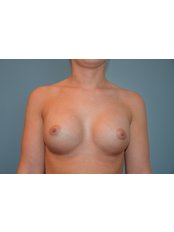 Brustimplantate - Body Feminization - Dr. Maarten Doornaert