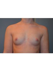 Breast Implants - Body Feminization