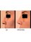 Dr Waskiewicz Witold Jr. - rhinoplasty before after 