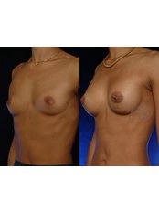 Breast Implants - Coupure Centrum for Plastic Surgery