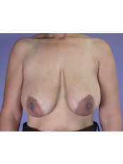 Areola Reduction - QC Medical Centre