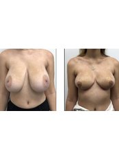 Breast Reduction - Dr. Esta Bovill