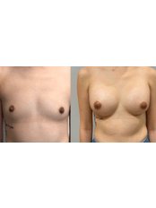 Breast Implants - Dr. Esta Bovill