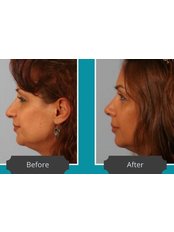 Rhinoplasty - Younger Facial Surgery Centre