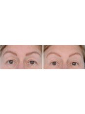 Eyelid Surgery - The Cosmetic Surgery Clinic