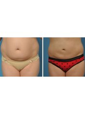 Liposuction - The Cosmetic Surgery Clinic
