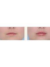 Lip Augmentation - The Cosmetic Surgery Clinic