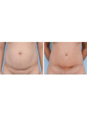 Tummy Tuck - The Cosmetic Surgery Clinic