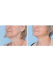Facelift - The Cosmetic Surgery Clinic