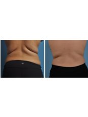 CoolSculpting® - The Cosmetic Surgery Clinic