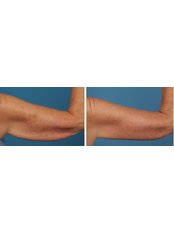 Arm Lift - The Cosmetic Surgery Clinic