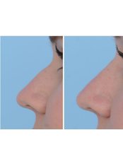 Non-Surgical Nose Job - The Cosmetic Surgery Clinic