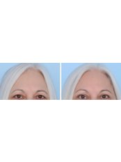 Brow Lift - The Cosmetic Surgery Clinic
