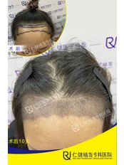 Hair Transplant - Guangdong Hanfei Plastic Surgery Hospital Co., LTD