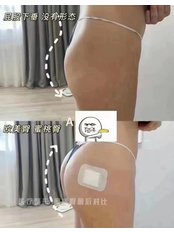 Butt Lift - Guangdong Hanfei Plastic Surgery Hospital Co., LTD