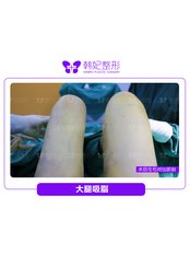 Thigh Liposuction - Guangdong Hanfei Plastic Surgery Hospital Co., LTD
