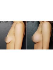 Breast Implants - Guangdong Hanfei Plastic Surgery Hospital Co., LTD