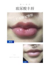Lip Filler - Guangdong Hanfei Plastic Surgery Hospital Co., LTD