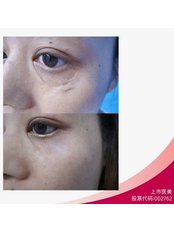 Scar Removal - Guangdong Hanfei Plastic Surgery Hospital Co., LTD
