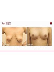 Breast Lift - Guangdong Hanfei Plastic Surgery Hospital Co., LTD