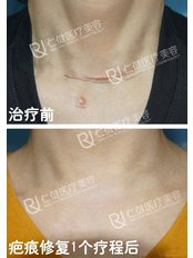 Scar Removal - Guangdong Hanfei Plastic Surgery Hospital Co., LTD