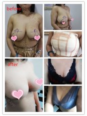 Breast Reduction - Guangzhou Hanfei Medical Cosmetology Huamei Flagship