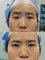Guangzhou Hanfei Medical Cosmetology Huamei Flagship - ptosis correction 