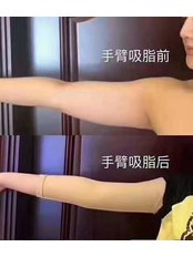Arm Liposuction - Guangzhou Hanfei Medical Cosmetology Huamei Flagship