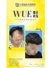 Hair Transplant - Guangzhou Hanfei Medical Cosmetology Huamei Flagship