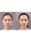 Guangzhou Hanfei Medical Cosmetology Huamei Flagship - face liposuction 