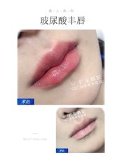 Lip Filler - Guangzhou Hanfei Medical Cosmetology