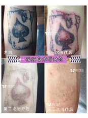 Tattoo Removal - Guangzhou Hanfei Medical Cosmetology