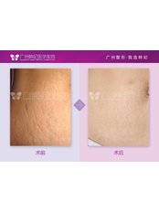 Stretch Marks Removal - Guangzhou Hanfei Medical Cosmetology